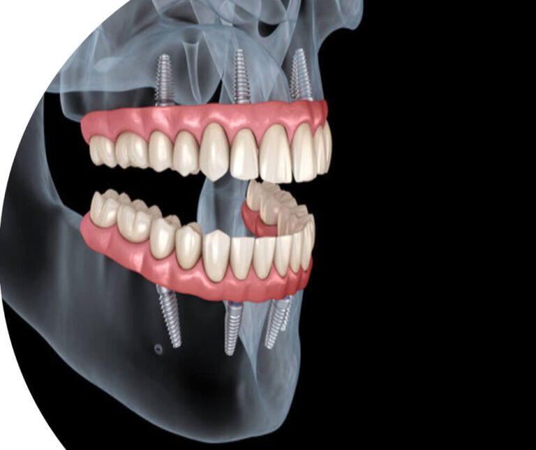 Low cost dental clinic in Chennai Best dental hospital in Chennai