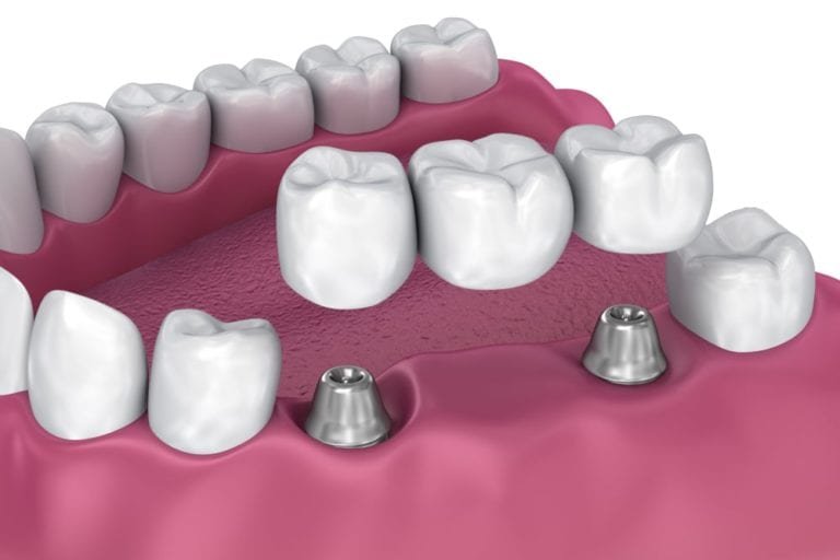 Dental-Bridge