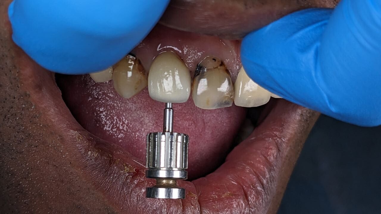 All on 4 dental implants cost in India All on four dental implants