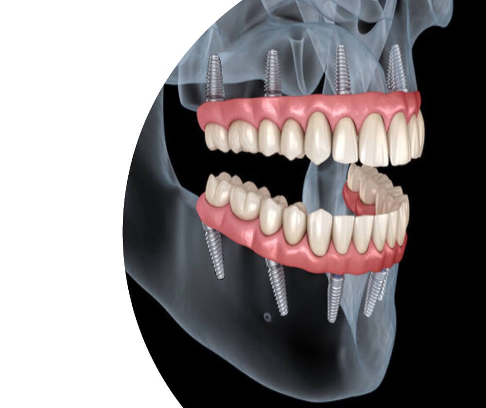 all-on-6-dental-implants-treatment-chennai-india-doctorprem