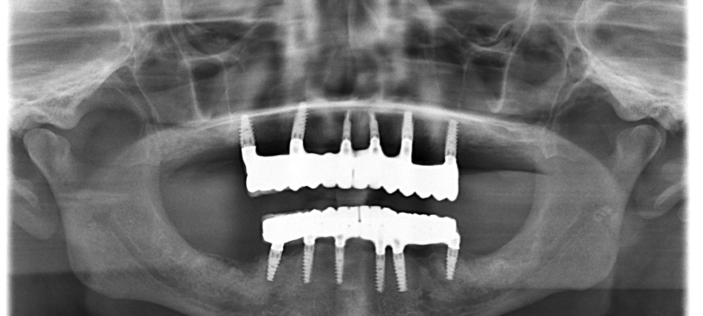full-mouth-implants-cost-in-india-chennai