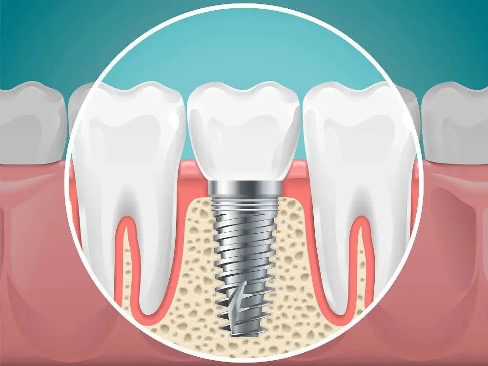 dental-implants-in-india