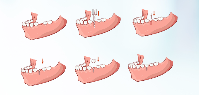 single-tooth-dental-implant-cost-in-india