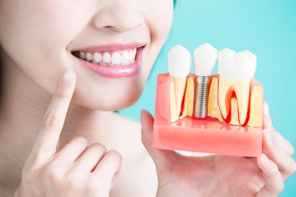 dental-implants-cost-in-india