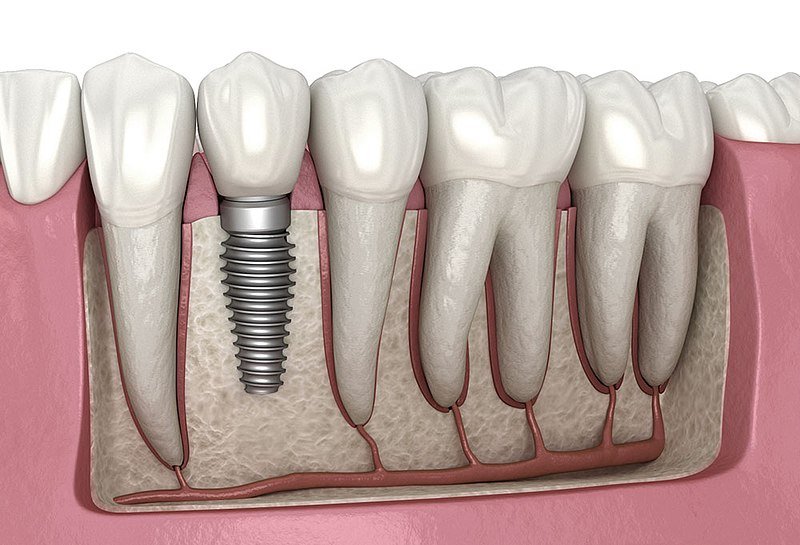 dental-implants-in-chennai