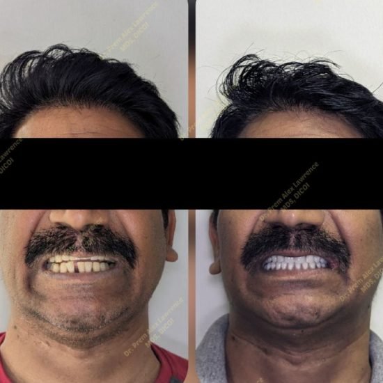 full-mouth-dental-implants-cost-in-india